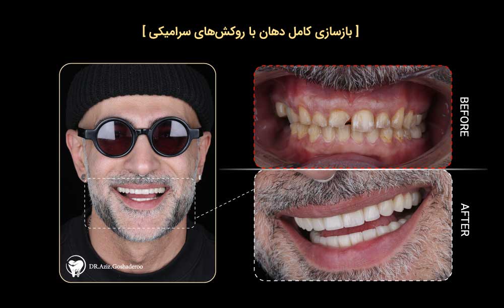 بازسازی کامل دهان با روکش&zwnj;های سرامیکی و درمان پروتزی